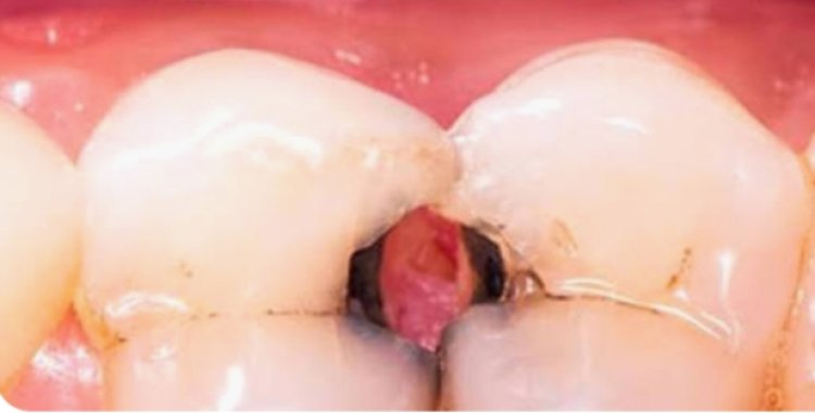 Health Tips : अगर आप दांतों में लगे कीड़े से हैं परेशान...तो देसी नुस्खे अपनाकर मिनटों में निकालें बाहर...