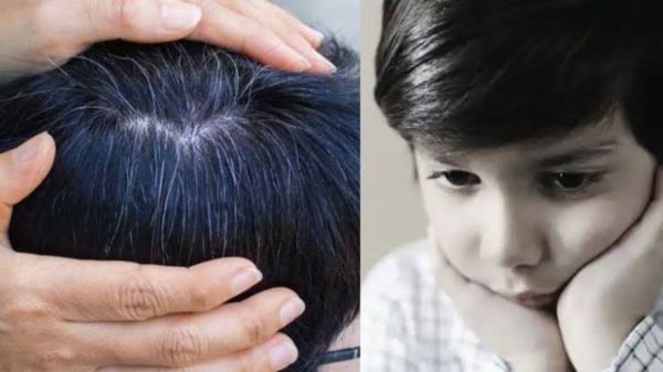 क्या आपके बच्चे के भी सर में दिखने लगे हैं सफेद बाल? तो हो सकती है इन Vitamins की कमी