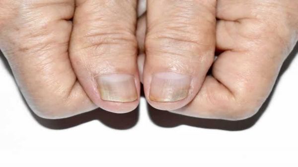 Health Tips: नीले नाखून हो सकते हैं गंभीर समस्या का संकेत, कब लें डॉक्टर से सलाह&hellip;