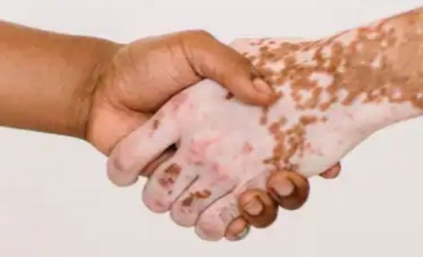 किस विटामिन की कमी से हो जाते हैं सफेद दाग?..इन चीजों से तुरंत मिल सकती है राहत